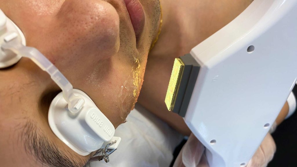 IPL in the Aesthetics Industry