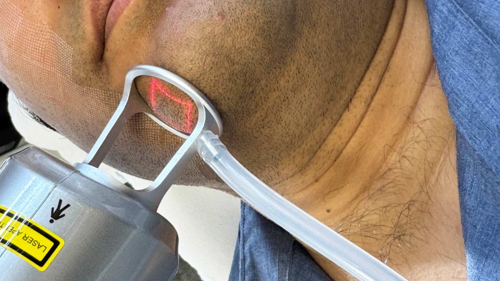 Fractional CO2 Laser Technology