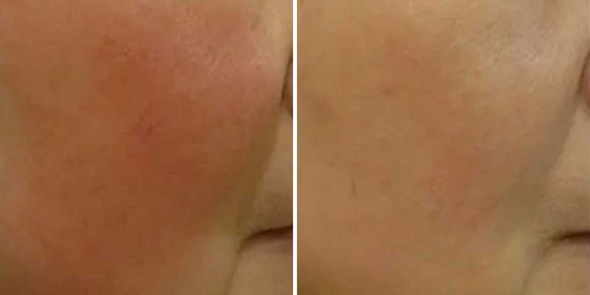 before-after-04