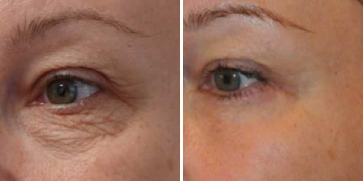 before-after-02