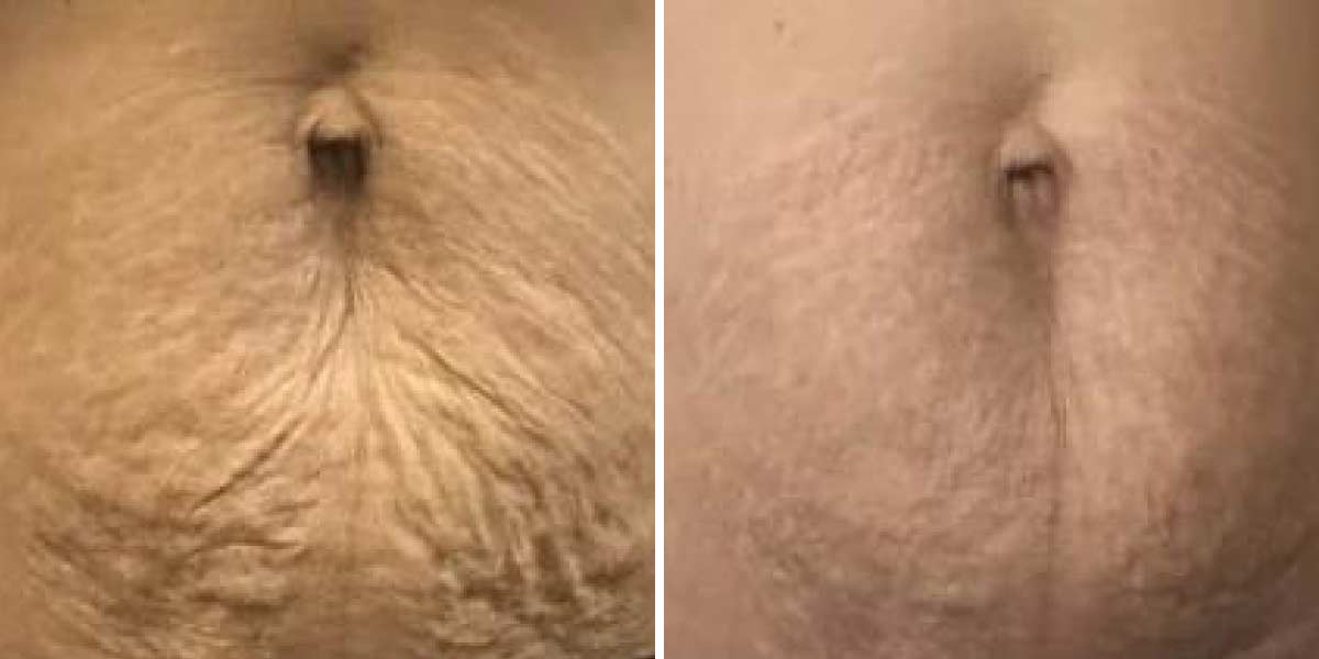 before-after-05