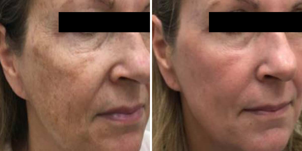 before-after-06