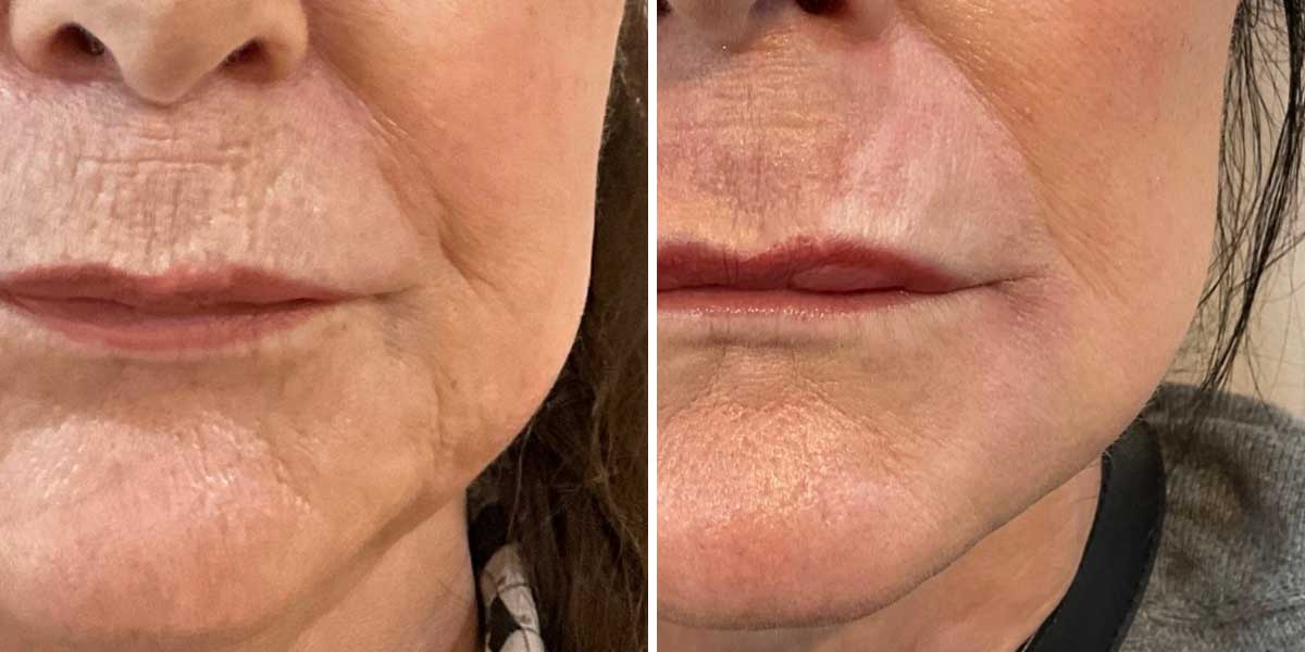 before-after-01