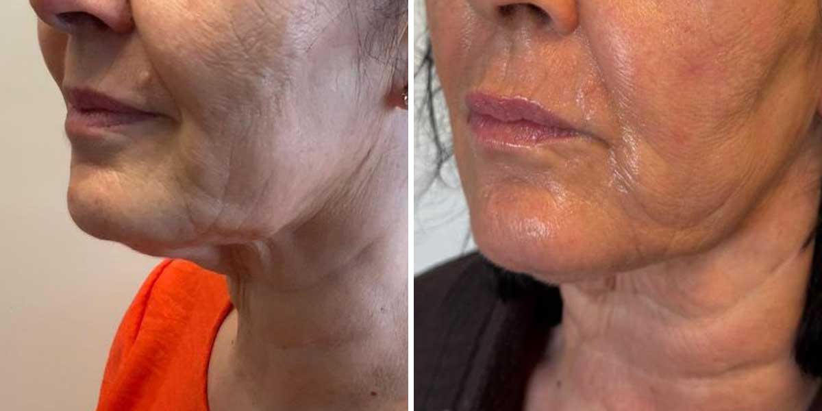 before-after-02